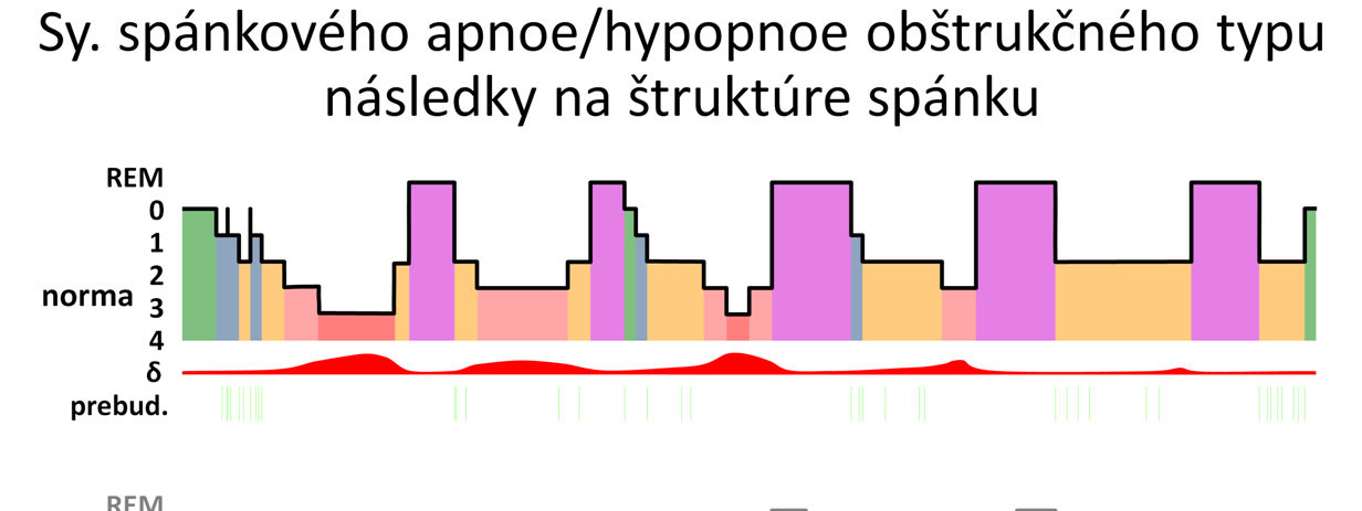 Na tejto schéme sú zobrazené následky spánkových porúch dýchania na štruktúru spánku. Takéto schématickézobrazenie štruktúry celonočného spánku sa nazýva celonočný hypnogram.