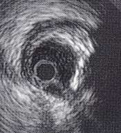 RA= RAProx +RADist 2 Luminal stenosis = RA-MLA RA Εγγύο ηκήκα