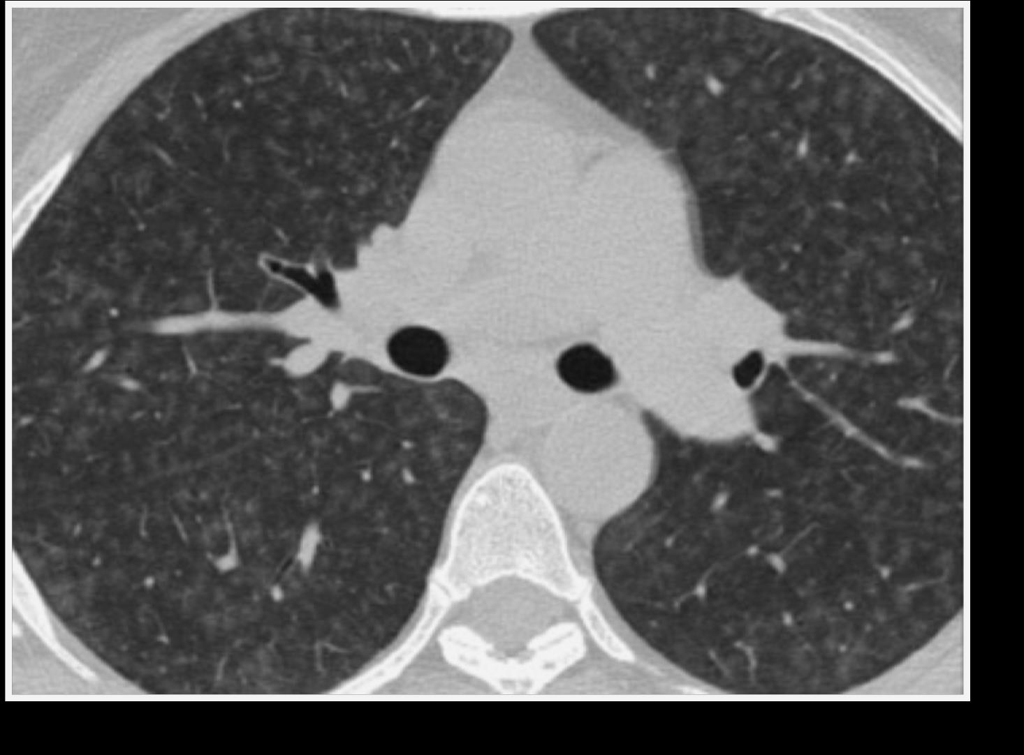 HRCT scan in a patient with subacute HP demonstrates