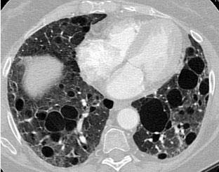 A 70-year-old woman with history of Sjögren syndrome presented with complaints of progressive cough and dyspnea.