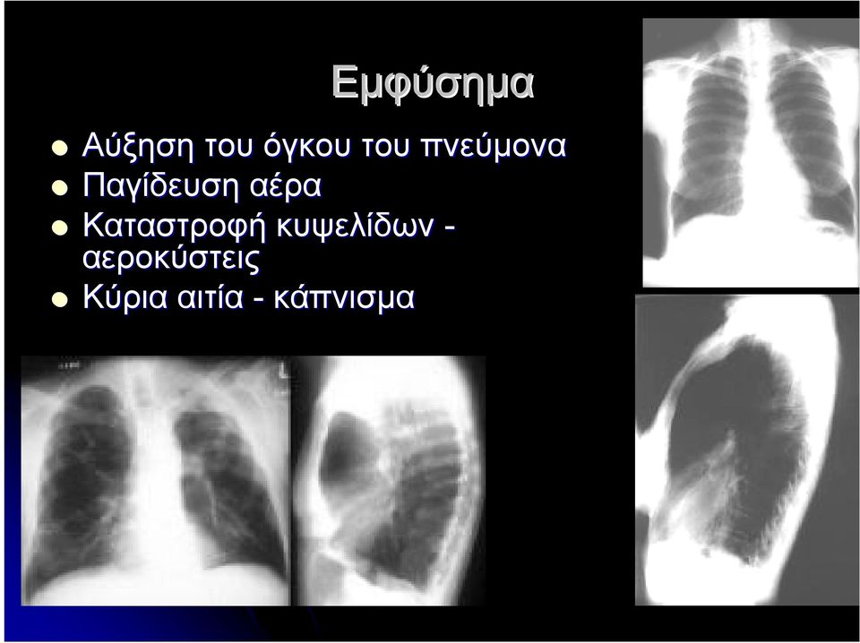 Καταστροφή κυψελίδων -