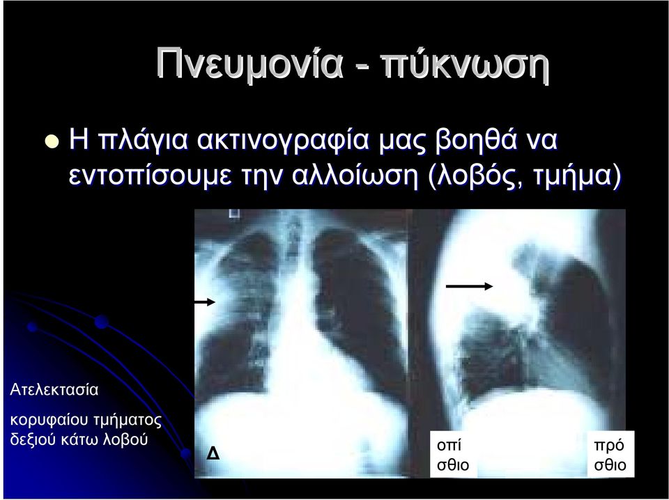 την αλλοίωση (λοβός, τμήμα) Ατελεκτασία