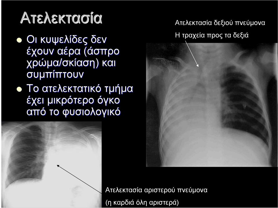 όγκο από το φυσιολογικό Ατελεκτασία δεξιού πνεύμονα Η τραχεία