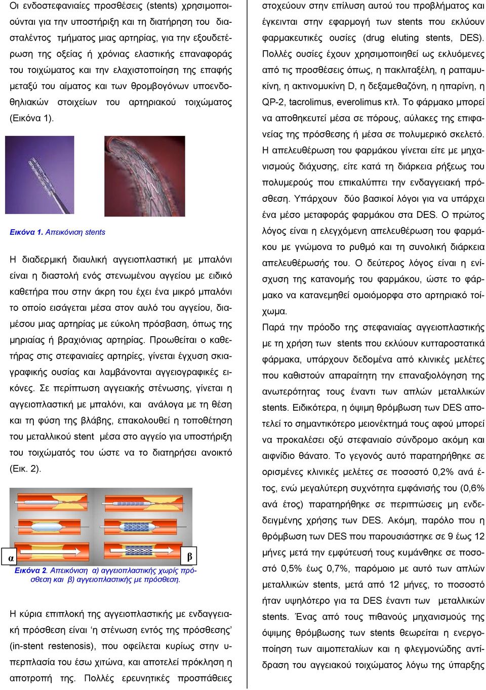 Απεικόνιση stents H διαδερμική διαυλική αγγειοπλαστική με μπαλόνι είναι η διαστολή ενός στενωμένου αγγείου με ειδικό καθετήρα που στην άκρη του έχει ένα μικρό μπαλόνι το οποίο εισάγεται μέσα στον