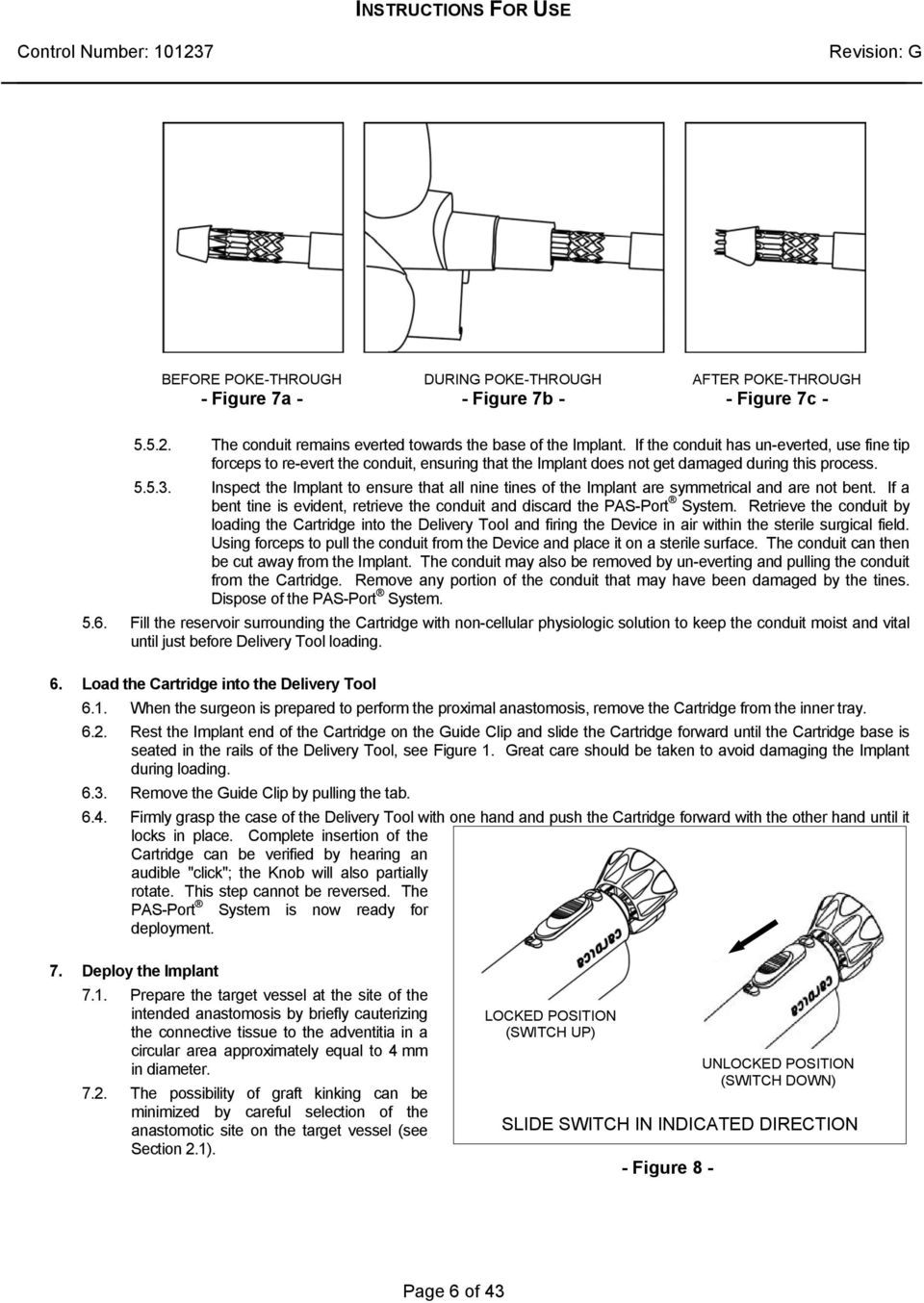 Inspect the Implant to ensure that all nine tines of the Implant are symmetrical and are not bent. If a bent tine is evident, retrieve the conduit and discard the PAS-Port System.