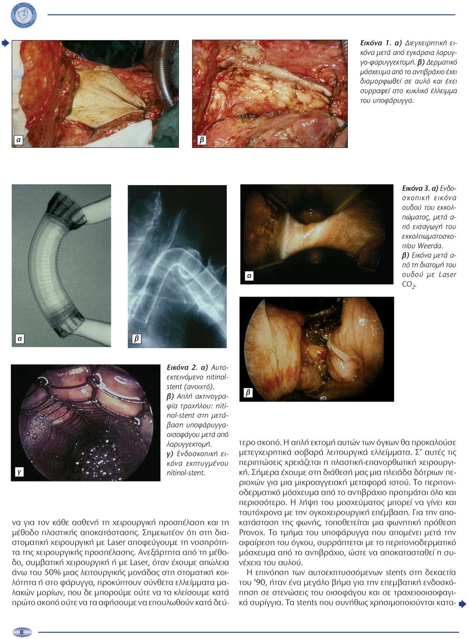 ) Απλή κτινογρφί τρχήλου: nitinol-stent στη μετάση υποφάρυγγοισοφάγου μετά πό λρυγγεκτομή. γ) Ενδοσκοπική εικόν εκπτυγμένου nitinol-stent.