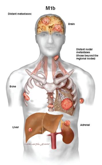 ΠΑΡΑΓΩΝ Μ (METASTASIS) ΤΝΜ 7