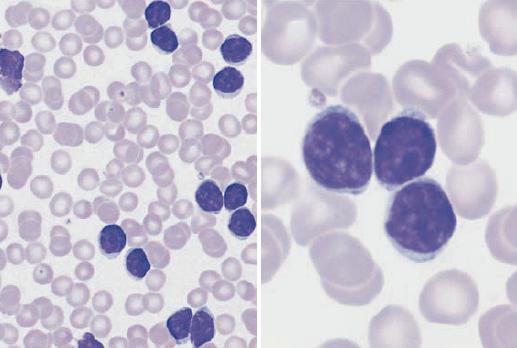 Διάγνωση > 5000/μl μονοκλωνικά Β λεμφοκύτταρα στο περιφερικό αίμα μικρά, μορφολογικά ώριμα λεμφοκύτταρα στην κυτταρολογική εξέταση Color Atlas of Hematology