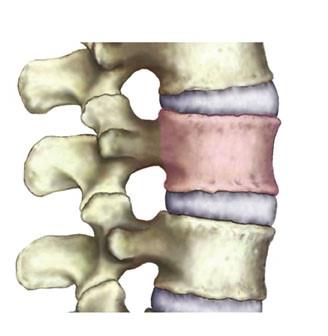Ισθμική Σπονδυλόλυση Σπονδυλολίσθηση