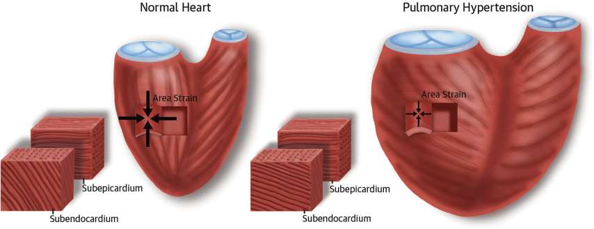 Remodeling δεξιάσ κοιλίασ απο δοςθ τθσ ΕΣΩ ( area strain) & ζξω (CS) ςτιβάδασ Smith Β,.