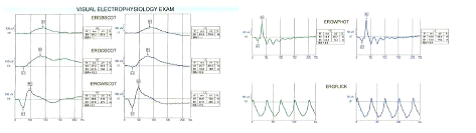 4.6 Χαρακτηριστικά του φυσιολογικού ηλεκτροαμφιβληστροειδογραφήματος Το ERG πλήρους πεδίου είναι η πιο συχνά χρησιμοποιούμενη μέθοδος ηλεκτροαμφιβληστρογραφήματος.