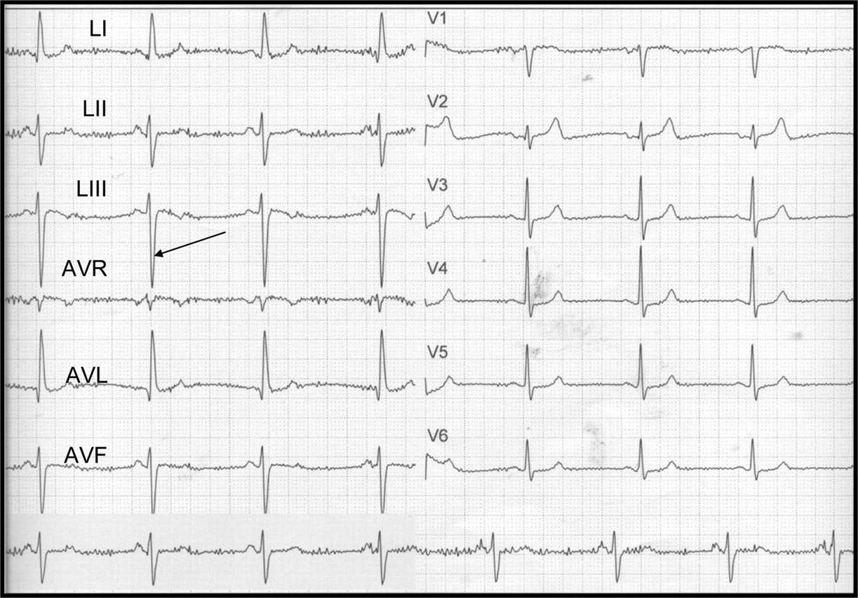 Figure 1. ECG of a 64-year-old woman with type 2 diabetes mellitus without other risk factors.