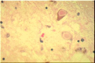 Εικόνα 2: Σωµάτια Lewy (http://www.pathology.vcu.edu/wirselfinst/neuro_medstudents/image/013lewy.