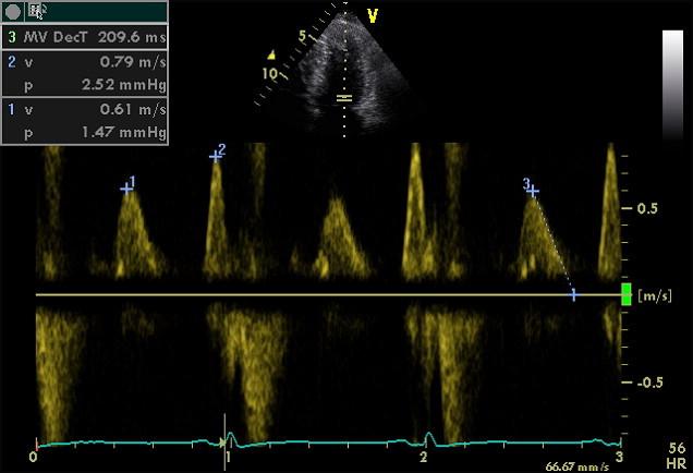 Διαμιτροειδική ροή E/Α E/Α<1, Ε 50cm/s Ε/ε (μέσο) <8 E/Vp <1,4 PAS<30mmHg S/D>1 Ar-A<0ms Ε 1-<2 ή Ε/Α<1,Ε 50cm/s Ε/ε (μέσο) >15 E/Vp 2.