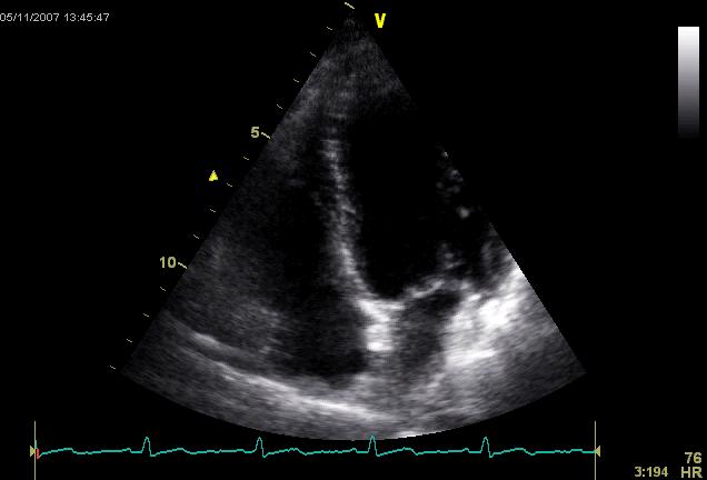 Δεξιά κοιλία-πνευμονική υπέρταση ESC Guidelines for the