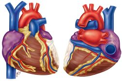 Lateral Infarct with ST