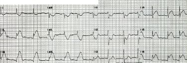 Practice 4 Inferior lateral MI Click for