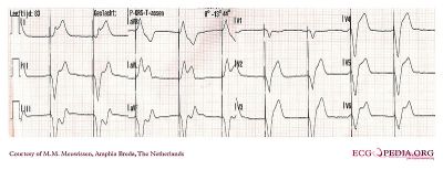 pacemaker