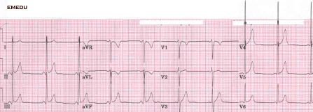 ST elevation of