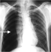 Pneumothorax:))Diagnosis) CXR:))Look)for) pleural)line)