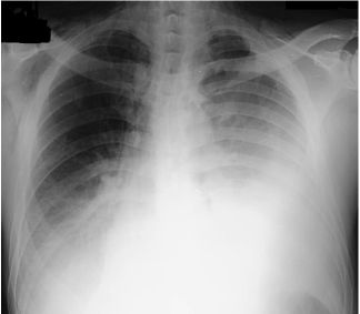 !!!! Esophageal)rupture:)Diagnosis) CXR:)))early)shows) mediasqnal)or)free)