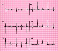 Cardiac Tamponade Low voltage complexes Electrical