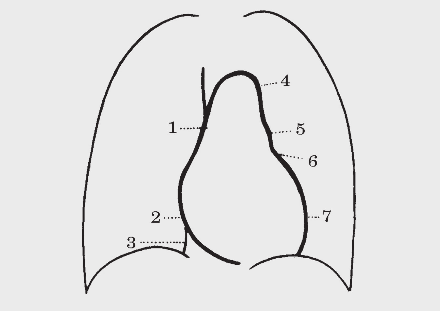 72 Βασικές Προβολές Αναπνευστικού Σύστηματος Οι ερωτήσεις 60-64 αναφέρονται στην παρακάτω εικόνα που δείχνει το σχήμα της καρδιαγγειακής σκιάς στην ο-π α/α θώρακα: Εικόνα 1.21. ( 1999 Κουμαριανός Δ.).