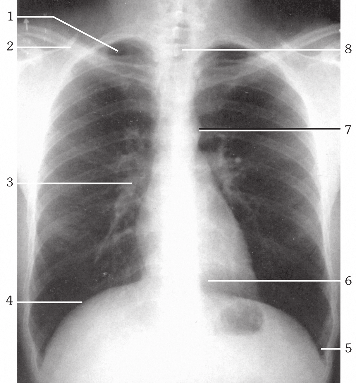 Βασικές Προβολές Αναπνευστικού Σύστηματος 73 Οι ερωτήσεις 65-69 αναφέρονται στην ακτινογραφική ανατομία της ο-π ακτινογραφίας θώρακα της παρακάτω εικόνας. Εικόνα 1.22. ( 1999 Κουμαριανός Δ.). 65. Ποιος αριθμός αντιστοιχεί στην κορυφή του πνεύμονα; 66.
