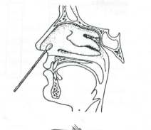 UZIMANJE - Obrisak nosa se uzima sterilnim, pamučnim i debljim, krutim štapićem kakvim se uzima i obrisak ždrijela. - Uroniti bris u sterilnu fiziološku otopinu.