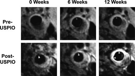 USPIO imaging on MR είναι μια υποσχόμενη τεχνική για την αξιολόγηση λεμφαδένα με χρήση των εξαιρετικά μικρών σωματιδίων