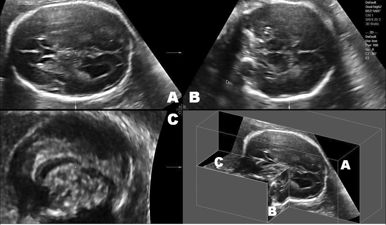 ΥΠΕΡΗΧΟΓΡΑΦΙΑ ΤΟΜ.8, ΤΕΥΧ.2, ΣΕΛ. 51-62, 2011 Εικόνα 1. Οι τρεις βασικές τομές της εξέτασης ρουτίνας του εγκεφάλου. Α: διακοιλιακή τομή, Β: διαθαλαμική τομή, Γ: διαπαρεγκεφαλιδική τομή.