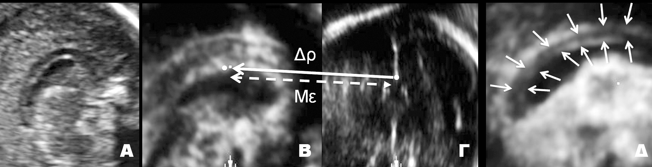ΥΠΕΡΗΧΟΓΡΑΦΙΑ ΤΟΜ.8, ΤΕΥΧ.2, ΣΕΛ. 51-62, 2011 Εικόνα 4. Απεικόνιση του μεσολοβίου σε δισδιάστατο (Α) και τρισδιάστατο (Β,Γ,Δ) υπερηχογράφημα.