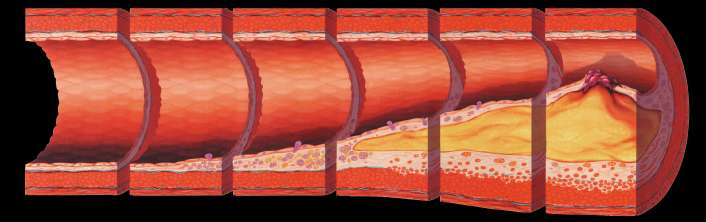 Atherosclerosis Timeline Foam Cells Fatty Streak Intermediate Lesion Atheroma Fibrous Plaque Complicated Lesion / Rupture From