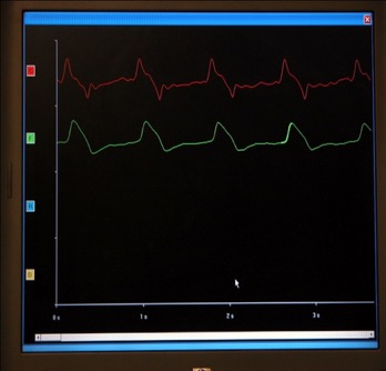 Procedures: c-f PWV estimation computerized method, by a validated device (Complior SP ) online recording and calculation of c-f PWV 2 different