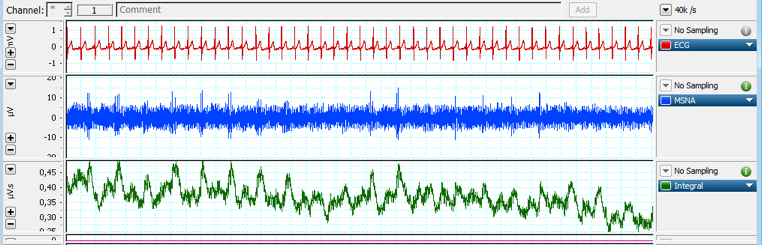 Characteristic MSNA recording in a resistant hypertensive patient with MS 58 bpm 58