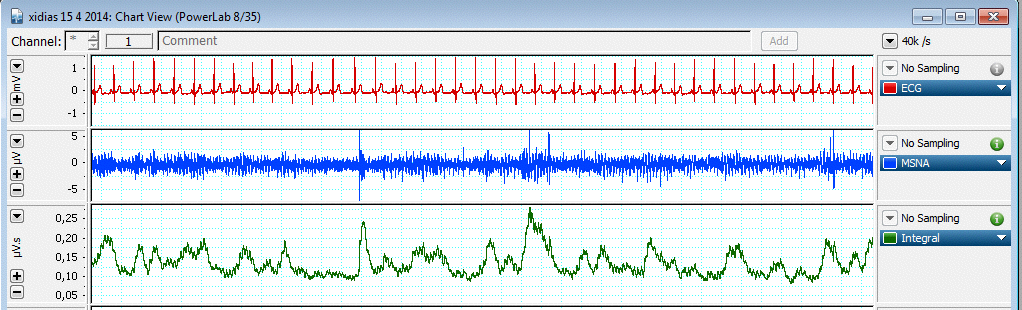 MSNA recording in a resistant hypertensive patient without MS 58