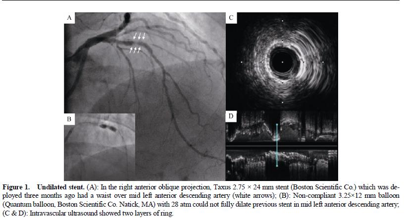 Stent unexpanded- An