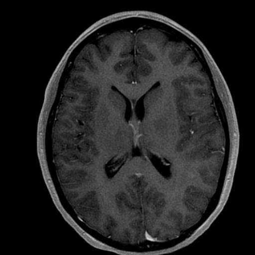 Το MRI μερικές φορές «υποτιμά» την βαρύτητα της κατάστασης