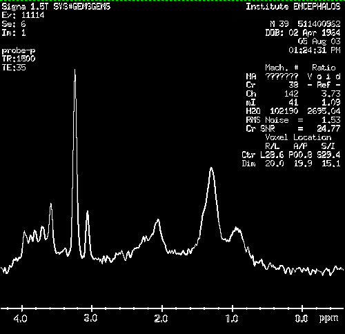 Γλοιώματα Grade I Grade II Grade III Grade IV Και στις τέσσερις περιπτώσεις η συγκέντρωση των κρεατινών είναι ίση ή υψηλότερη του φυσιολογικού (στο