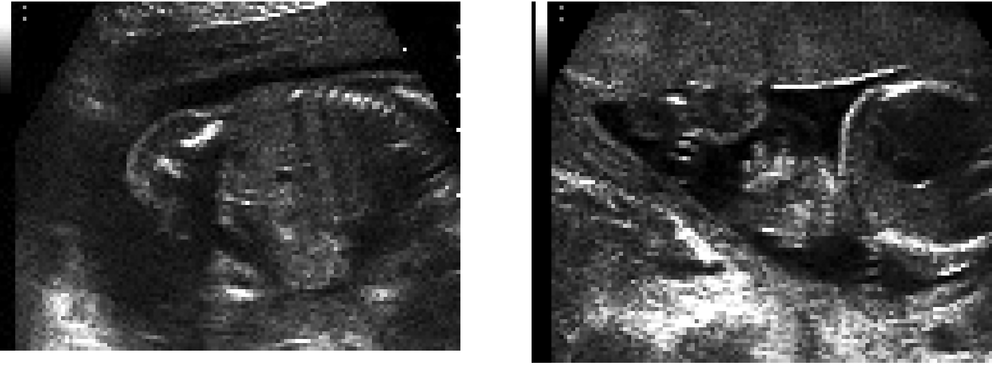 Ομφαλοκήλη Αραμπατζής και συν. Εικόνα 6: Υπερηχογραφική απεικόνιση γαστρόσχισης σε έμβρυο 19 εβδομάδων κύησης (εγκάρσια και επιμήκης τομή) νται απο πόλυάμνιο ή σπανιότερα ολιγάμνιο.