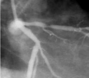 Myocardial Fractional Flow Reserve: Definition Fractional Flow Reserve is a ratio max FFR = flow in the stenotic Qsmaximal myocardial