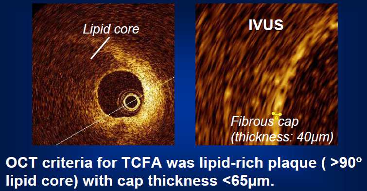 Optical Coherence Tomography