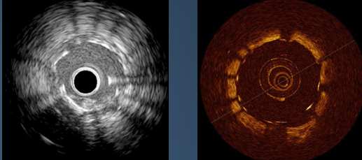 Optical Coherence Tomography