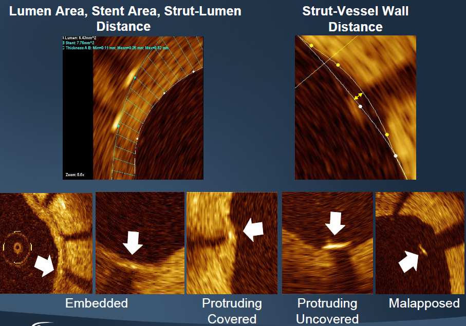 Optical Coherence Tomography Εκτίµηση