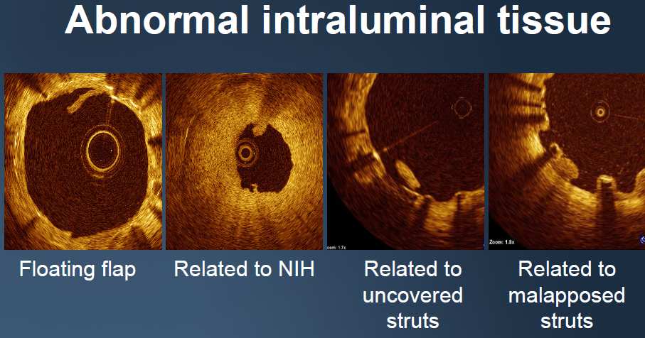 Optical Coherence Tomography Εκτίµηση