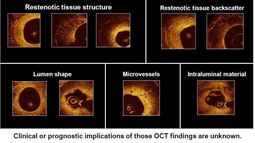 Optical Coherence Tomography Εκτίµηση του Μακροχρόνιου