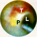 Thrombus Remains Following Thrombolysis