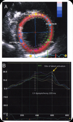 Pacing at the site of latest mechanical activation by echocardiographic strain analysis is associated