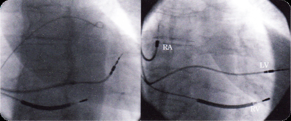 Active fixation lead is positioned (left),