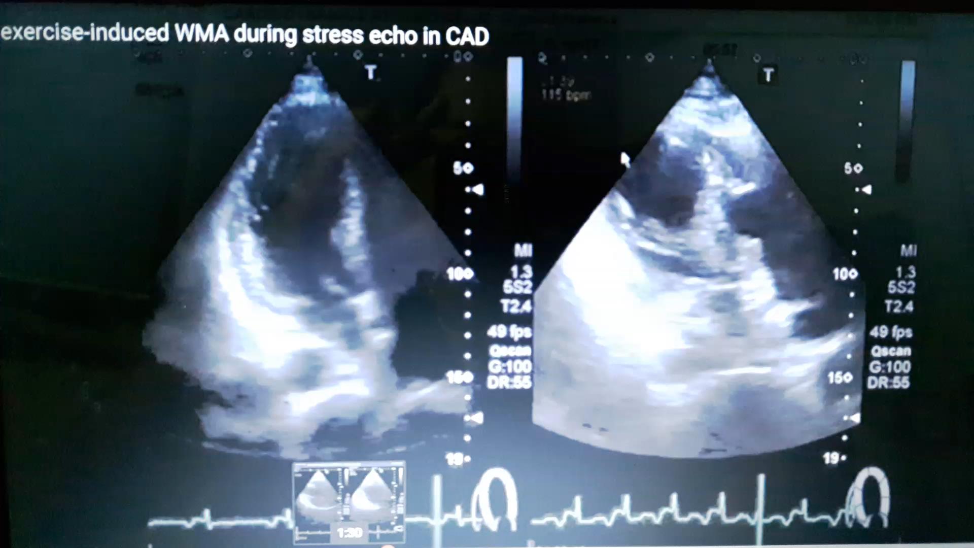 Stress echo Η δοβουταμίνη σε αρχική χαμηλή δόση ελέγχει την εφεδρία ενώ σε μέσες ή υψηλές δόσεις την ισχαιμία.